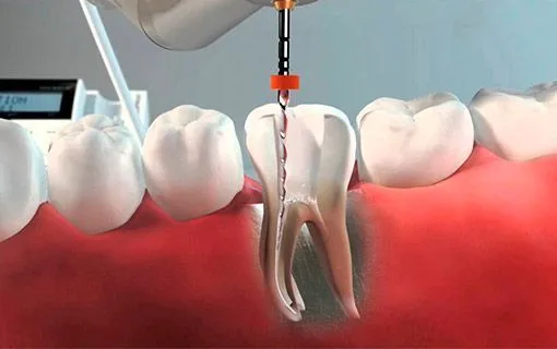 Tratamiento de endodoncia en Lima