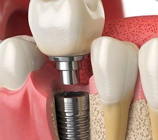Implantes dentales en Lima en V&C Odontólogos