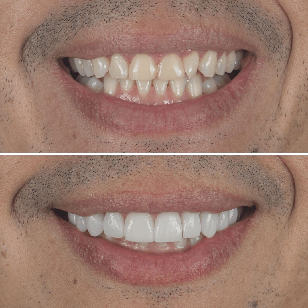 Carillas y estética dental en V&C Odontólogos
