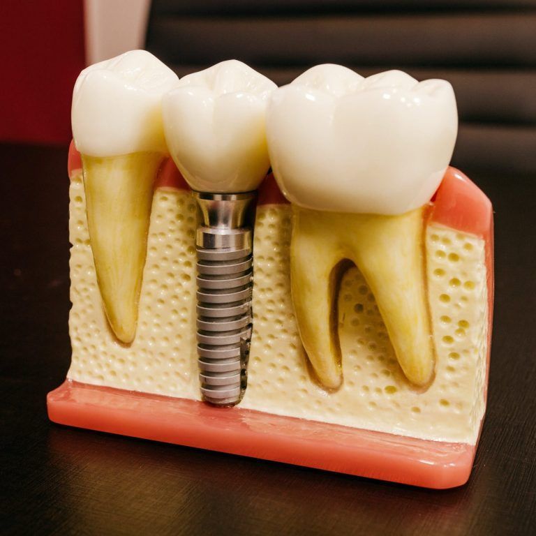 ¿Cuánto tiempo dura un implante dental?