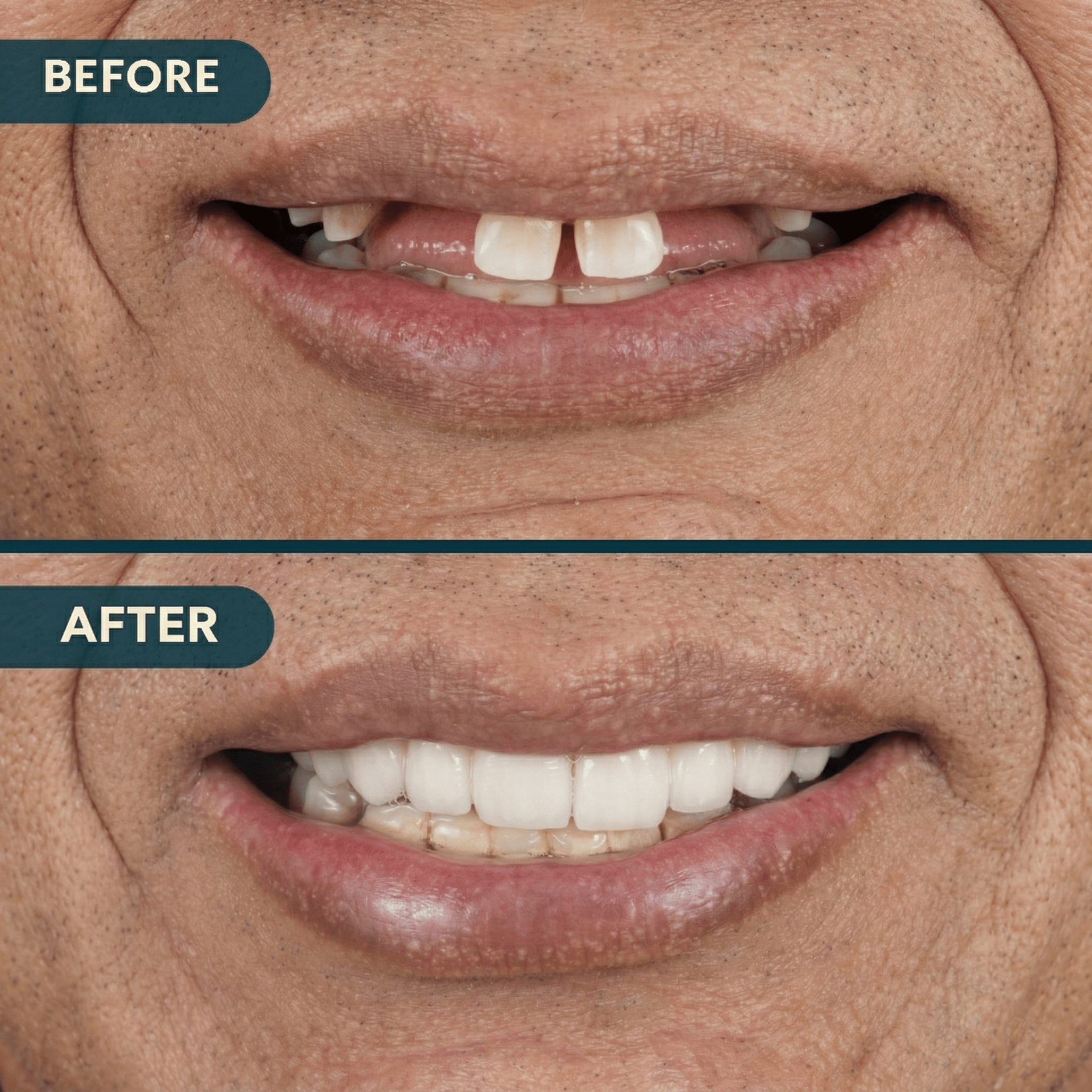 Before and after dental implant case 3