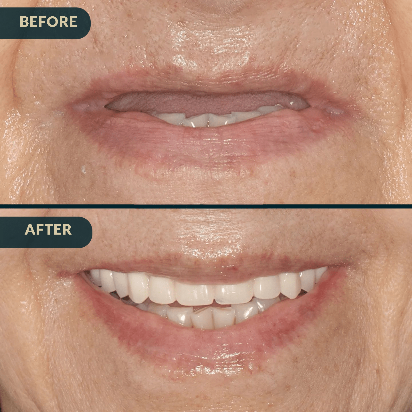 Before and after dental implant case 2