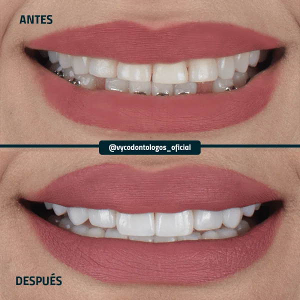 Antes y después de carillas dentales en V&C Odontólogos