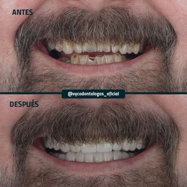 Antes y después de un caso de estética dental en V&C Odontólogos