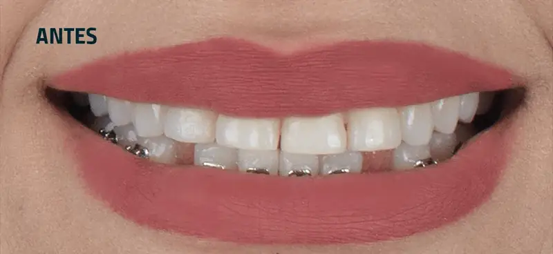 Sonrisa antes del tratamiento con carillas: dientes con forma irregular y restauraciones metálicas visibles