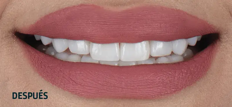 Sonrisa después de carillas: dientes uniformes en forma y color