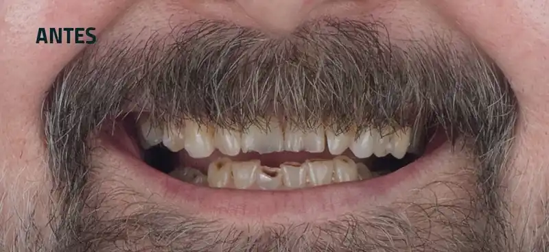 Sonrisa antes de carillas: dientes desgastados y con manchas