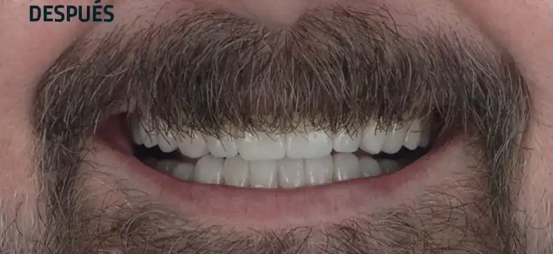 Sonrisa después de carillas: dientes claros y con bordes restaurados