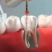 Ilustración de un tratamiento de endodoncia