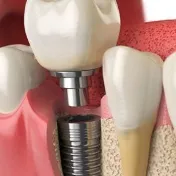 Implante dental colocado en el maxilar