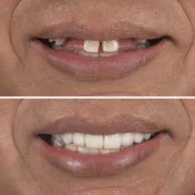 Antes y después de una rehabilitación oral